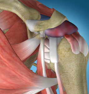 Shoulder Impingement Shoulder Impingement