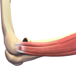 Tennis Elbow Tennis Elbow