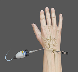 Why the Procedure is Performed
