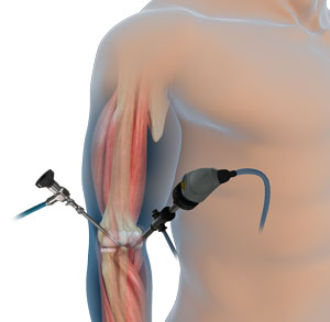 Elbow Arthroscopy Image Elbow Arthroscopy
