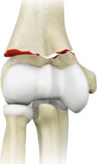 Elbow Fractures Image Elbow Fractures