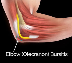 Elbow Bursitis Treatment Adelaide | Olecranon Bursitis Western Adelaide