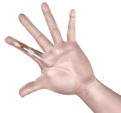 Flexor Tendon Injuries Flexor Tendon Injuries