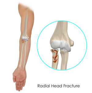 Radial Head Fractures of the Elbow Radial Head Fractures of the Elbow