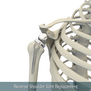 Reverse Shoulder Replacement Reverse Shoulder Replacement