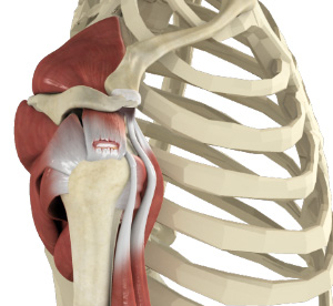 Rotator Cuff Tear