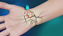 Scaphoid Fracture