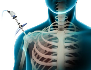 Shoulder Arthroscopy Shoulder Arthroscopy