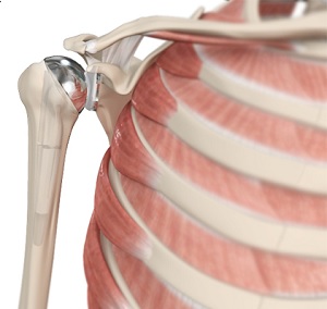 Shoulder Joint Replacement Shoulder Joint Replacement