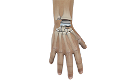 Wrist Joint Replacement Wrist Joint Replacement